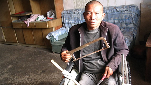 Zheng Yanliang, de 47 anos, começou a sentir fortes dores nas pernas em janeiro de 2011, de acordo com reportagem do “Huffington Post” | Foto: Reprodução